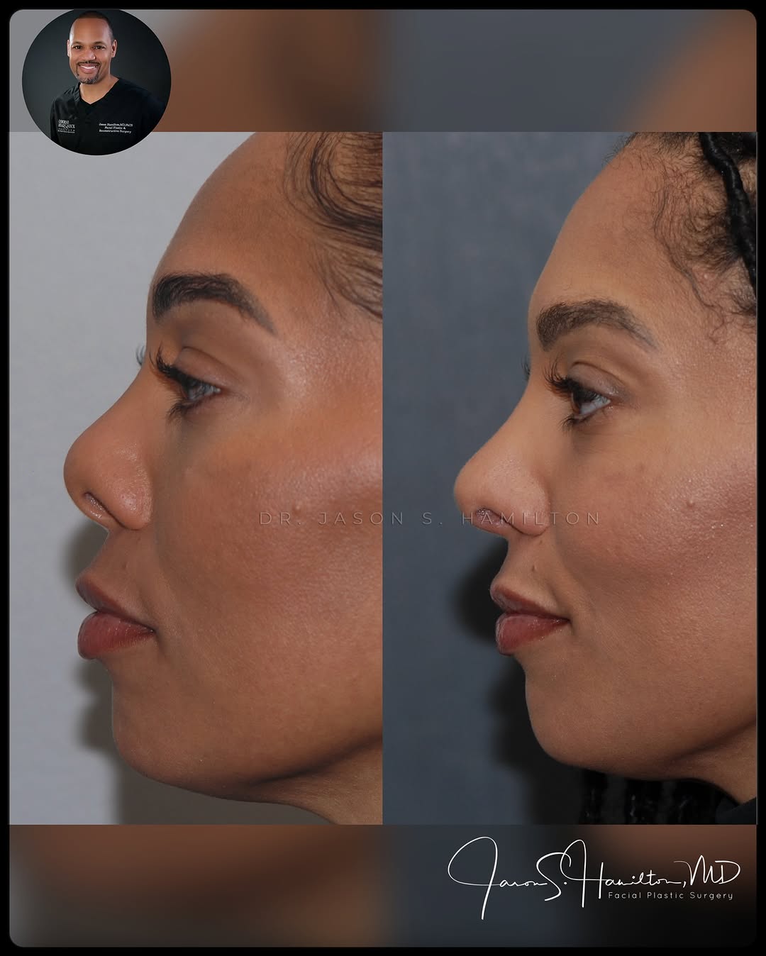 Instagram post by Dr. Jason S. Hamilton: Keeping nasal tips grounded👃🏼!!Grounded aesthetics in rhinoplasty are key. Aiming for the perfect balance between your nose’s tip and brid…