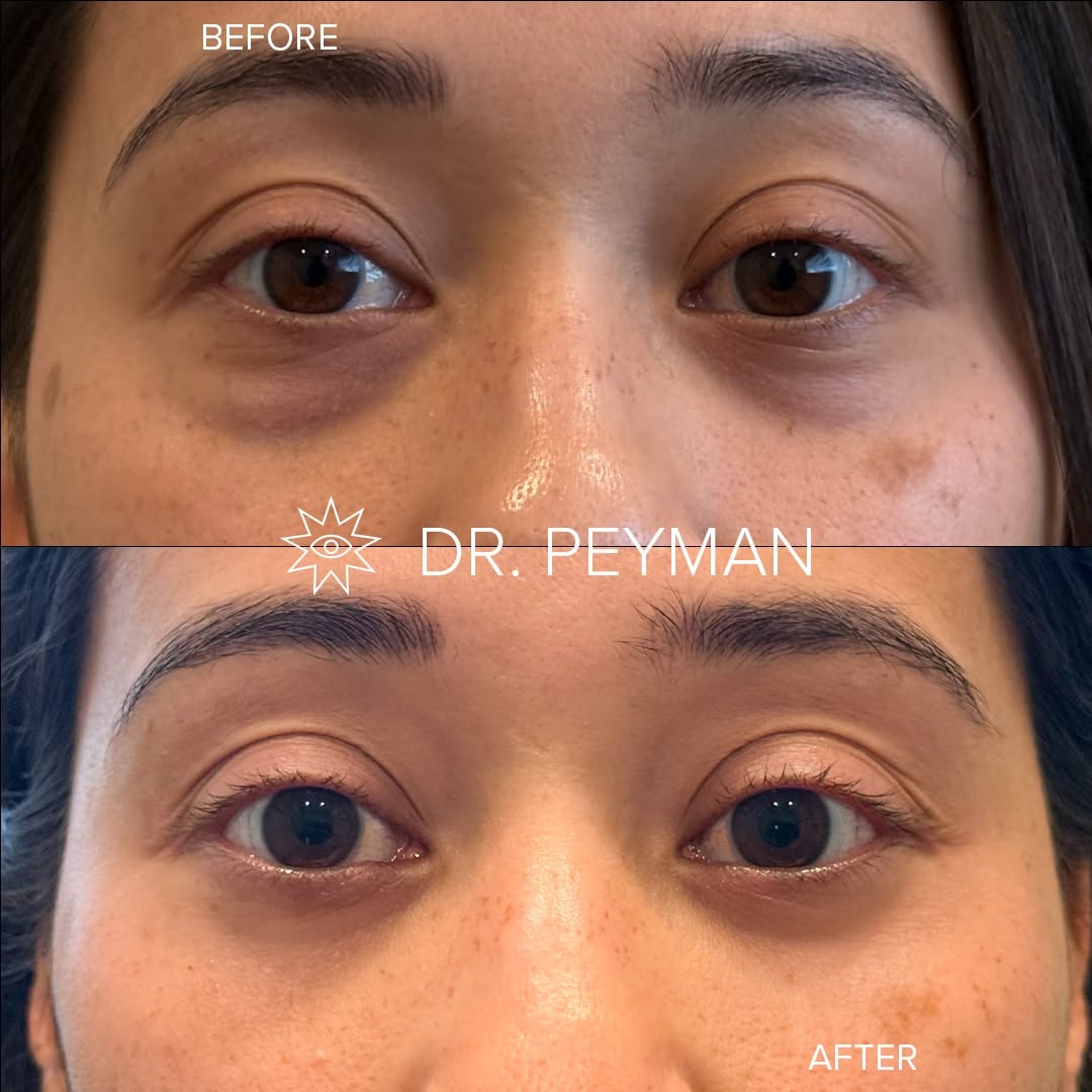 Instagram post by Dr. Jason Sabet-Peyman: Too young for eyelid surgery? That may not be the case. 👁️✨ This patient is in her 30s and came to us with under eye bags that no eye cream…