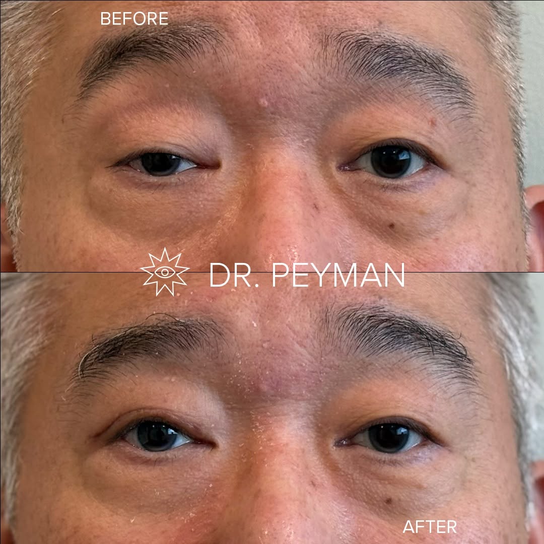 Instagram post by Dr. Jason Sabet-Peyman: Not every drooping eyelid is an excess skin problem. If one eye sits lower than the other, it is often ptosis, a weakening of the levator mu…