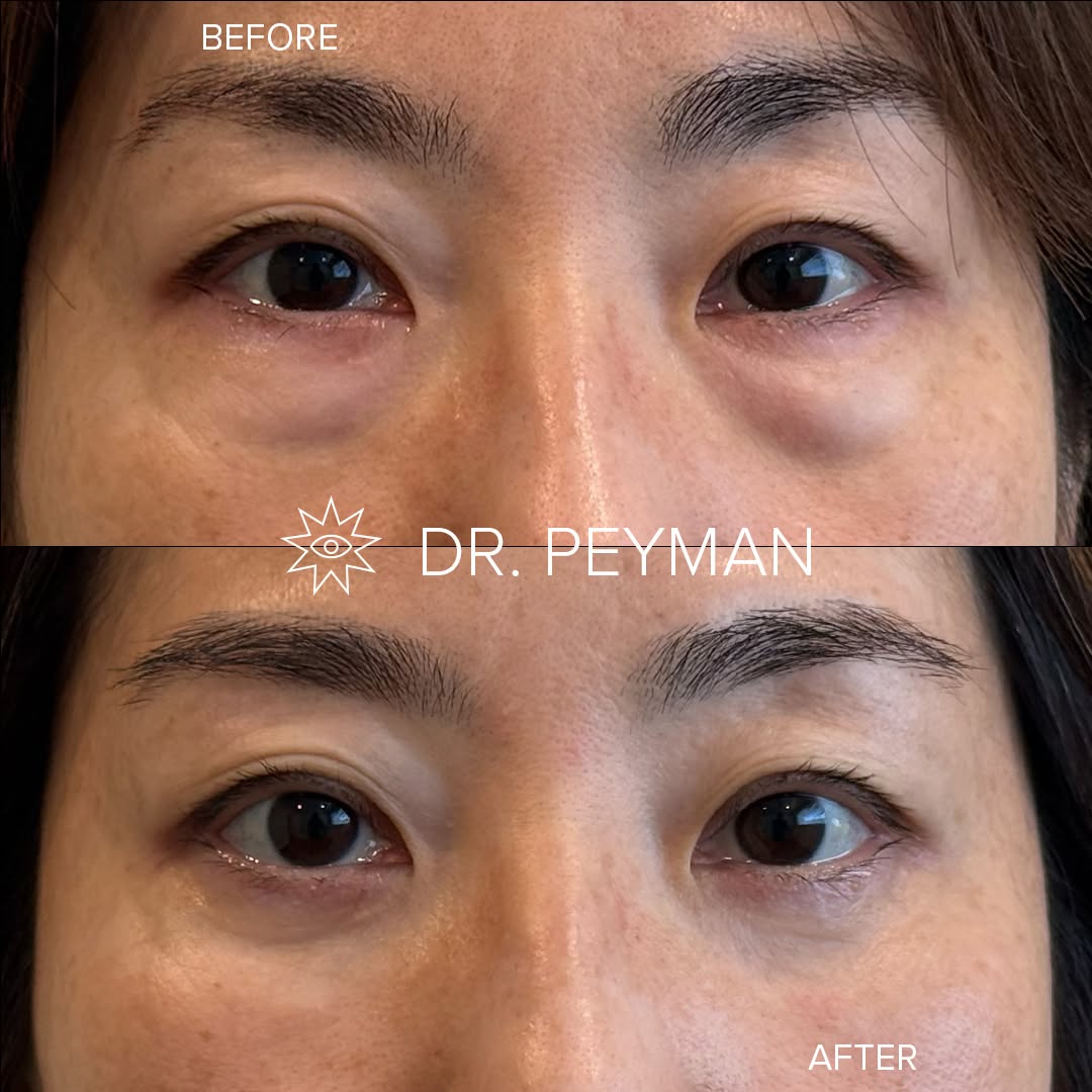Instagram post by Dr. Jason Sabet-Peyman: This patient had under-eye bags that no amount of sleep or skincare was going to fix. The puffiness beneath both lower lids was structural, …
