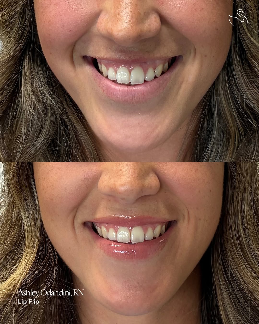 Instagram post by Dr. Jason Tomsic, DO: Consider this your sign to add the Lip Flip. A subtle upper-lip enhancement, a little more lip show when you smile, and the perfect finishin…