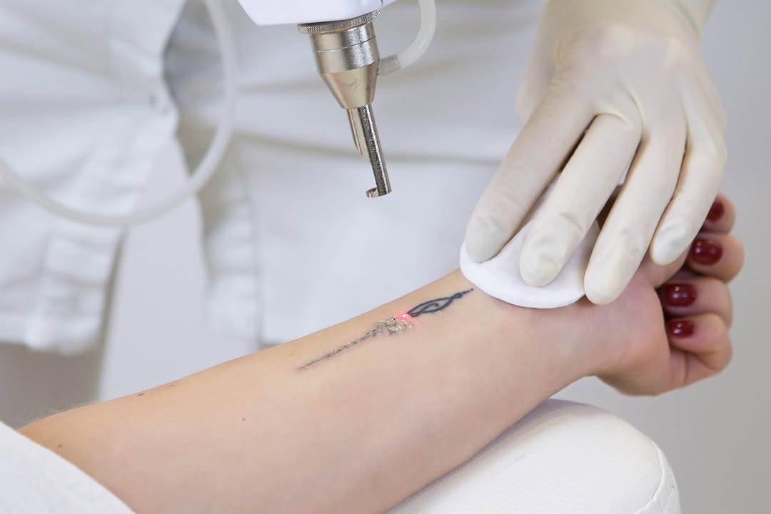 Instagram post by Dr. Jayne Fortson: Considering tattoo removal? Fortson Dermatology & Skin Care Center in Anchorage, AK, provides safe and effective options tailored to your ne…
