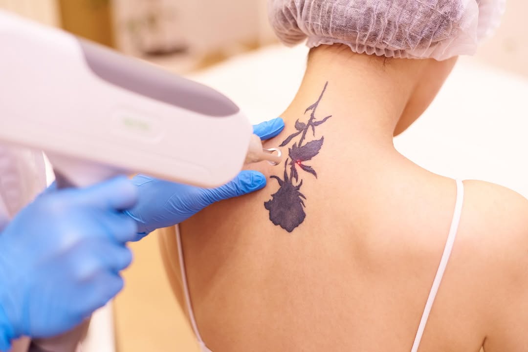 Instagram post by Dr. Jayne Fortson: Looking for tattoo removal services in Anchorage, AK? Fortson Dermatology & Skin Care Center delivers tailored treatments with a focus on yo…