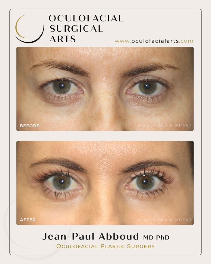 Instagram post by Dr. Jean-Paul Abboud: Upper Eyelid Rejuvenation This beautiful patient felt her upper lids were beginning to feel heavy, making her look more tired than she felt …