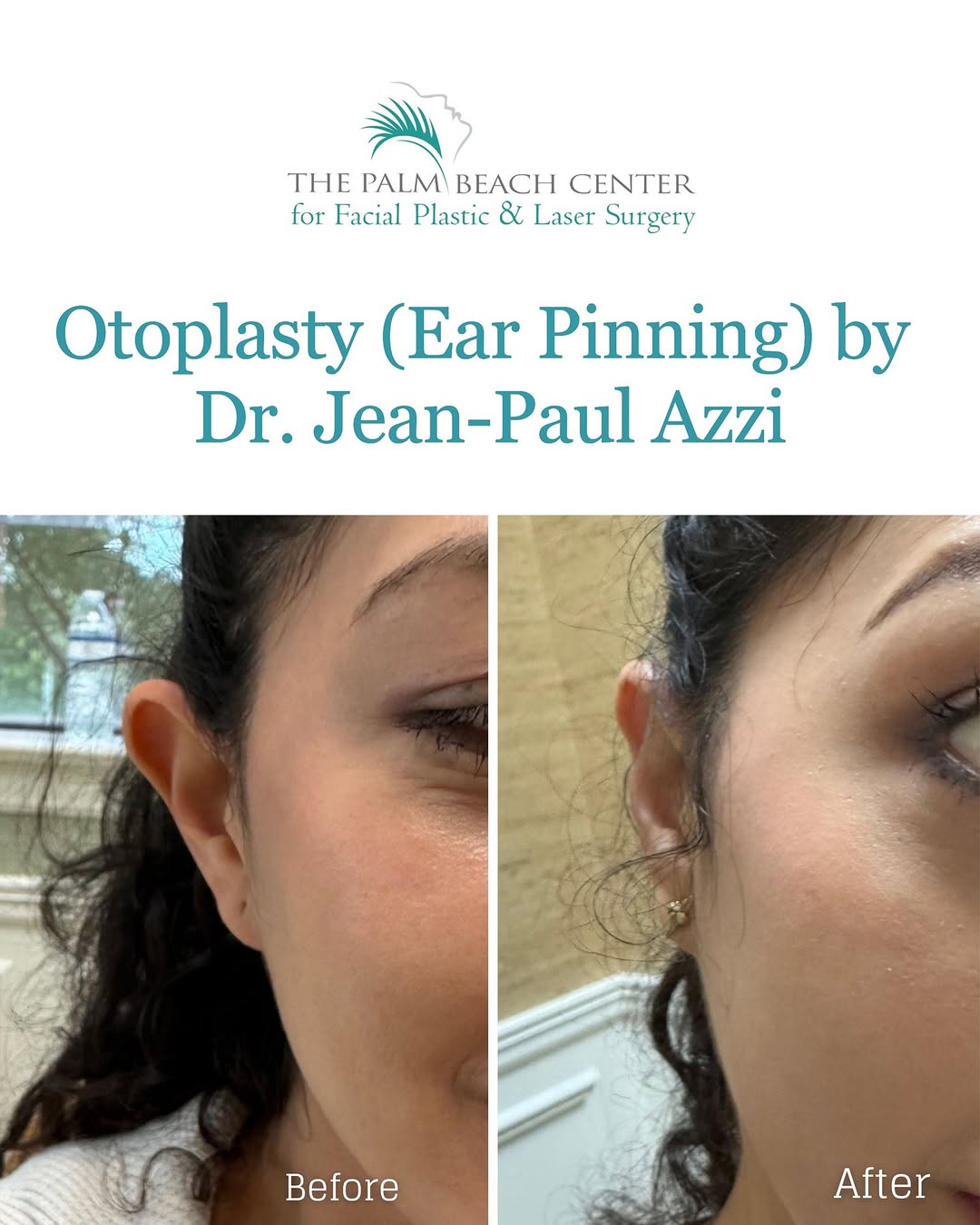 Instagram post by Dr. Jean-Paul Azzi: Otoplasty is a minimally invasive ear pinning procedure performed right here in our office without general anesthesia. By reshaping and repo…