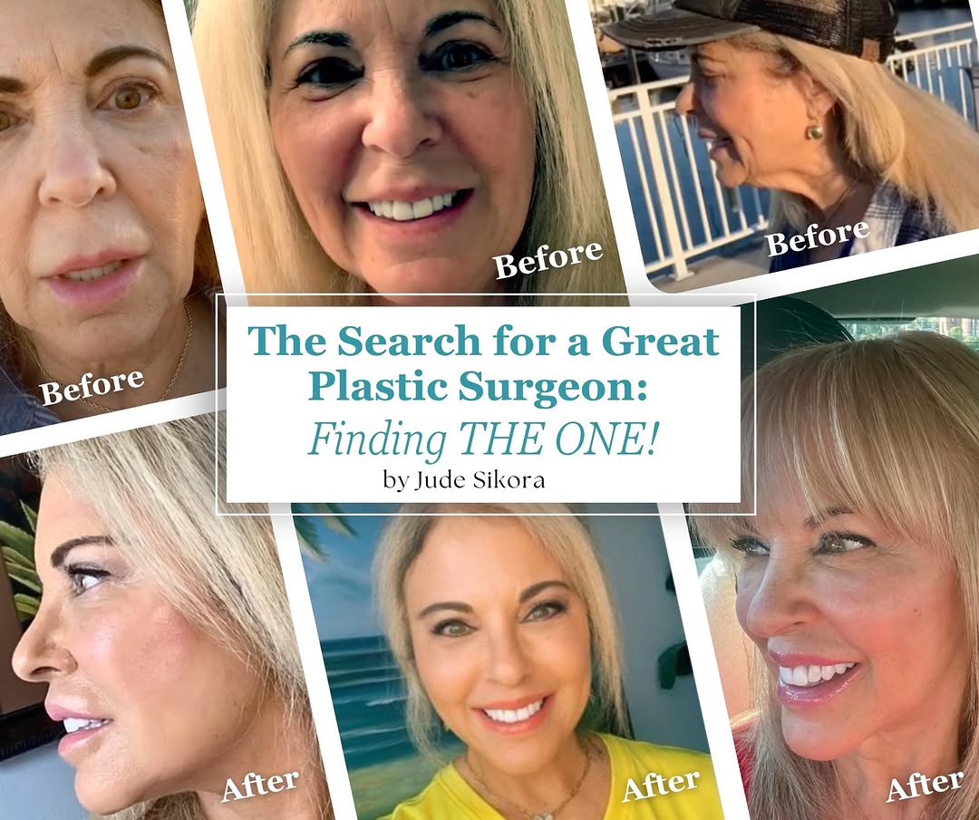 Instagram post by Dr. Jean-Paul Azzi: In this guest blog, our patient, Jude shares how Dr. Jean-Paul Azzi’s deep plane facelift—performed without general anesthesia—transformed h…