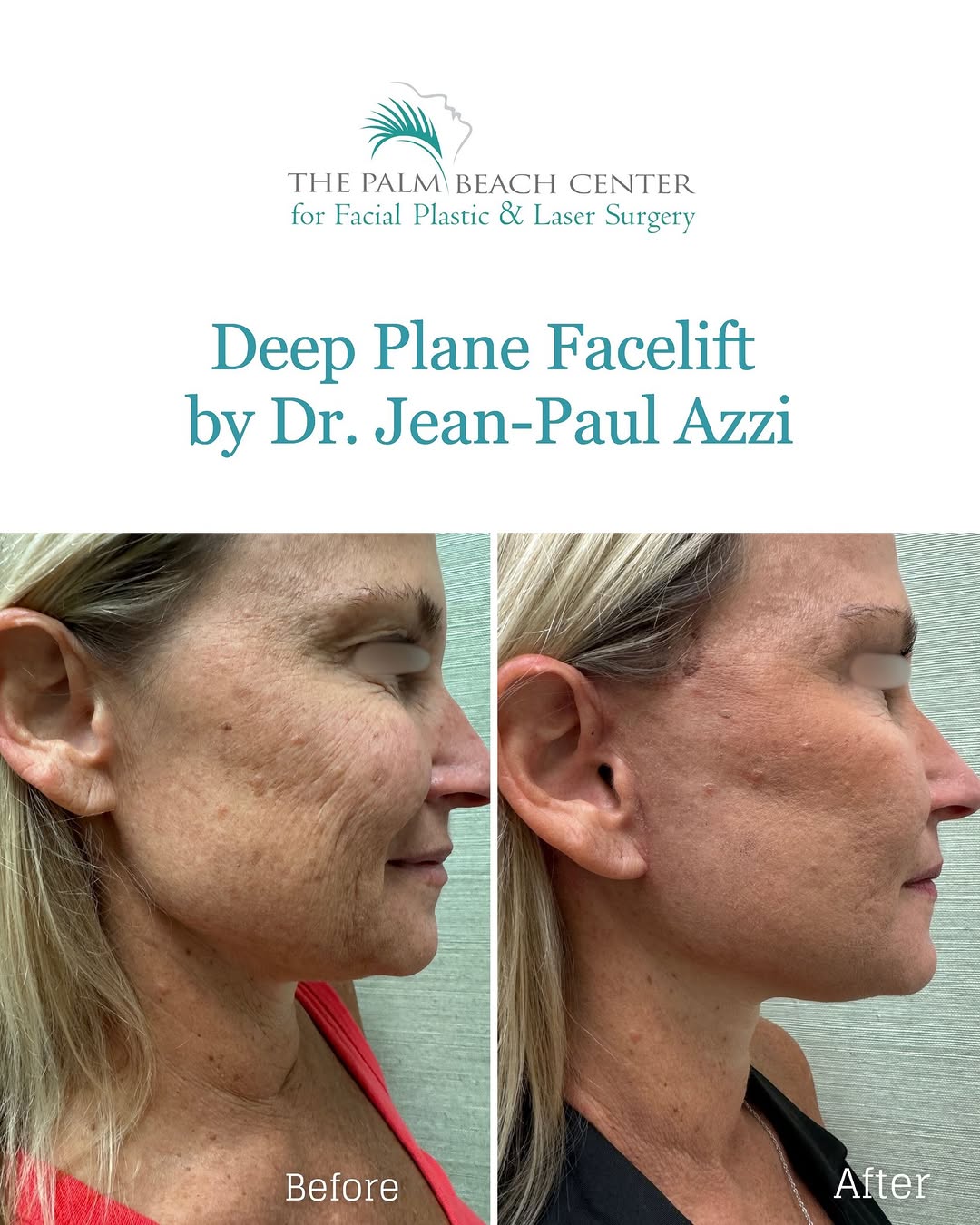 Instagram post by Dr. Jean-Paul Azzi: Just 2 weeks post-op. This beautiful patient underwent a deep-plane facelift with Dr. Jean-Paul Azzi. Her refreshed, natural look has taken …