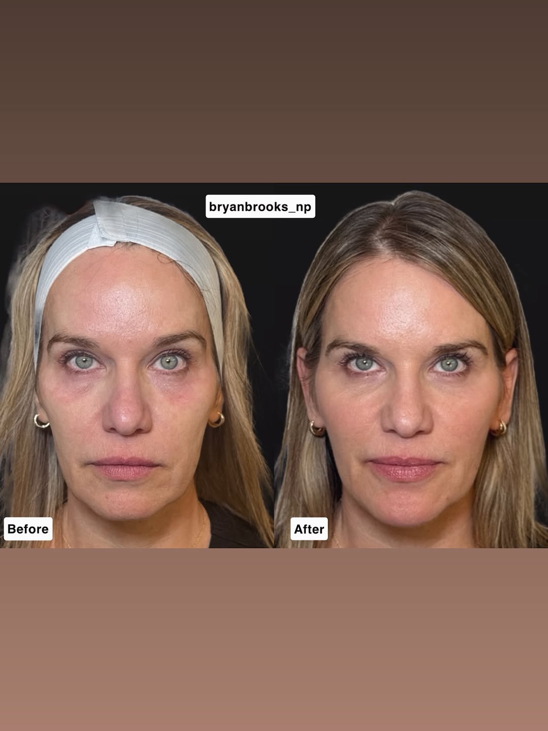 Instagram post by Dr. Jeanne Eyde, DO: These photos were taken ONE WEEK apart. 🤯 No surgery. No filters. No dramatic downtime. Just strategic facial balancing using hyaluronic ac…