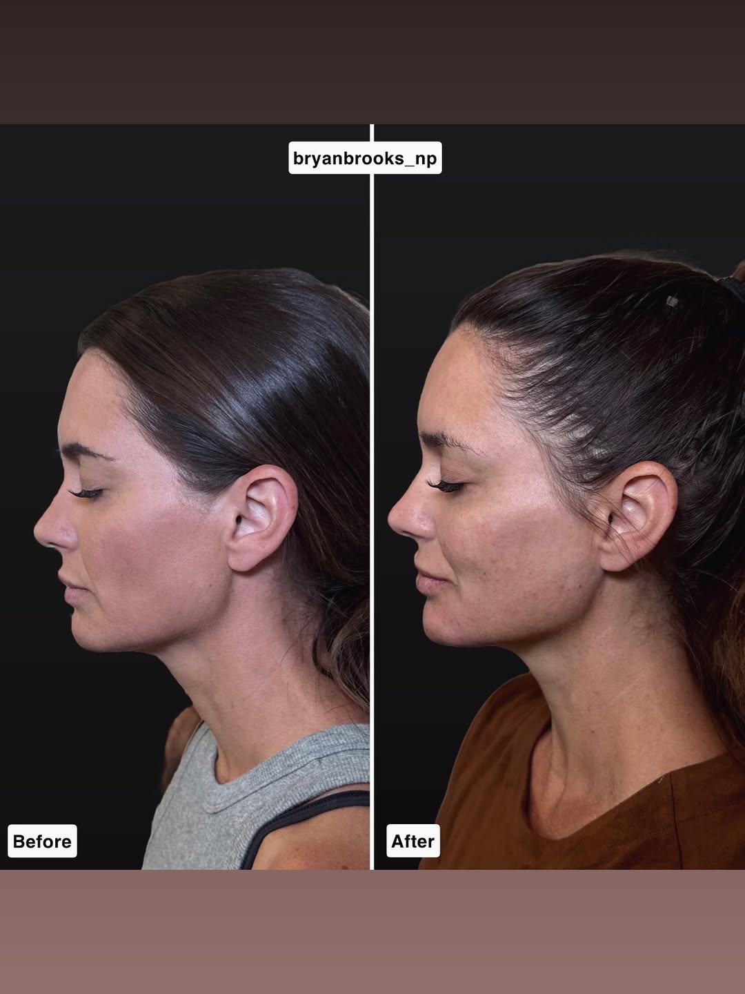 Instagram post by Dr. Jeanne Eyde, DO: Full-face rejuvenation through the MD Codes approach ✨ This treatment was performed using the MD Codes methodology under the guidance of the…