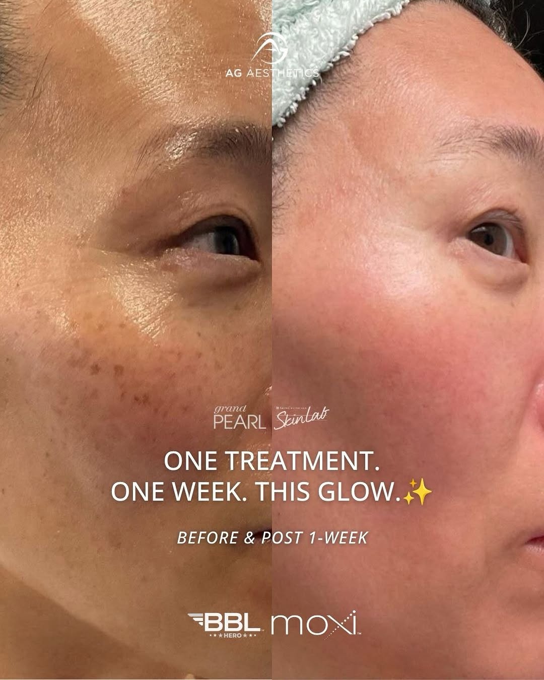 Instagram post by Dr. Jeanne Eyde, DO: 𝗙𝗟𝗔𝗪𝗟𝗘𝗦𝗦 𝗦𝗞𝗜𝗡 𝗜𝗡 𝗝𝗨𝗦𝗧 𝗢𝗡𝗘 𝗪𝗘𝗘𝗞! This patient received 1 BBL/Moxi stacked treatment with Sciton, with the photo on t…