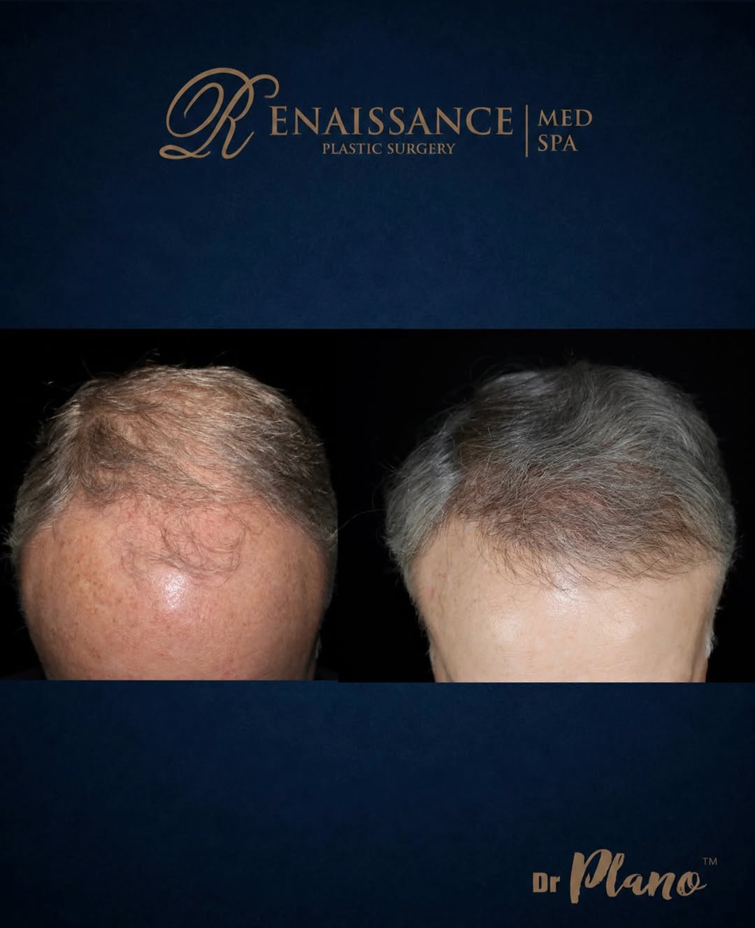 Instagram post by Dr. Jeff Angobaldo: FUE Micro-Graft Hair Transplant 🌱 9 months post-hair transplant Our Advanced FUE hair transplant technology provides a minimally invasive s…