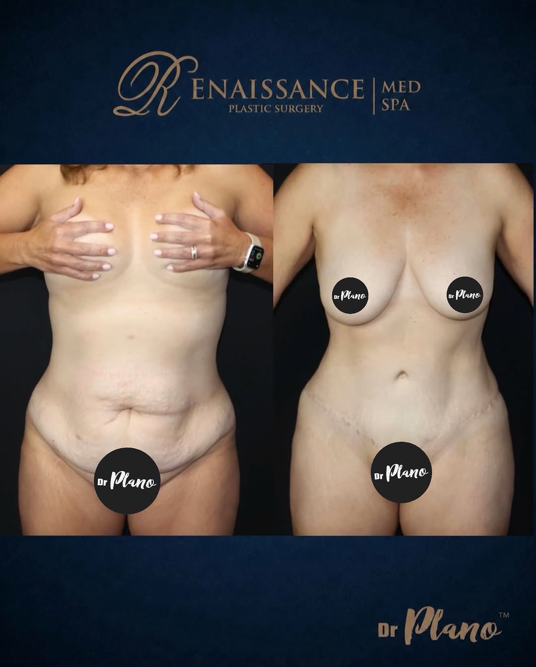 Instagram post by Dr. Jeff Angobaldo: Tummy tuck 💋 10 months post-op Book your consultation today (972) 378-3870 ✨ #drplano #plasticsurgeryclinic #tummytuck #plano #dfw