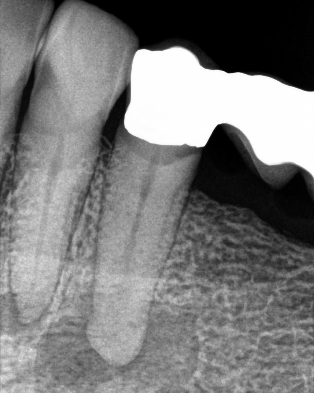 Instagram post by Dr. Jeff Kotsubo: Our GentleWave Clean Flow case this morning in #21. I would have never been able to consistently achieve this level of debridement to get th…