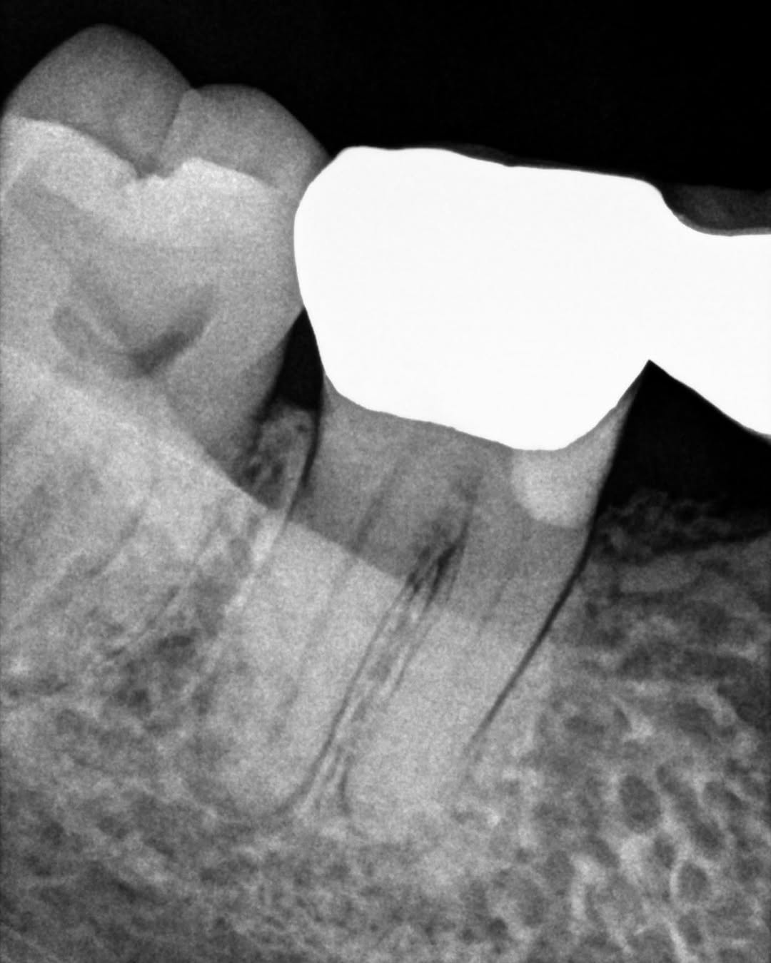 Instagram post by Dr. Jeff Kotsubo: Our really sweet patient this week. Asymptomatic #31 distal bridge abutment. GentleWave CleanFlow. Only two canal orifices evident. Mesial m…