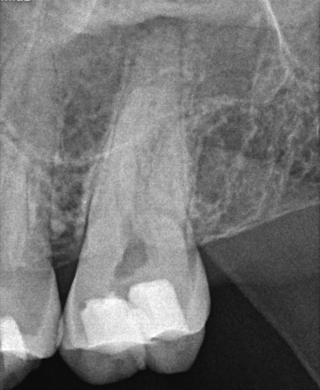 Instagram post by Dr. Jeff Kotsubo: Our afternoon GentleWave case from yesterday on #14. There was only one MB orifice present but files were getting caught up on a canal wall …