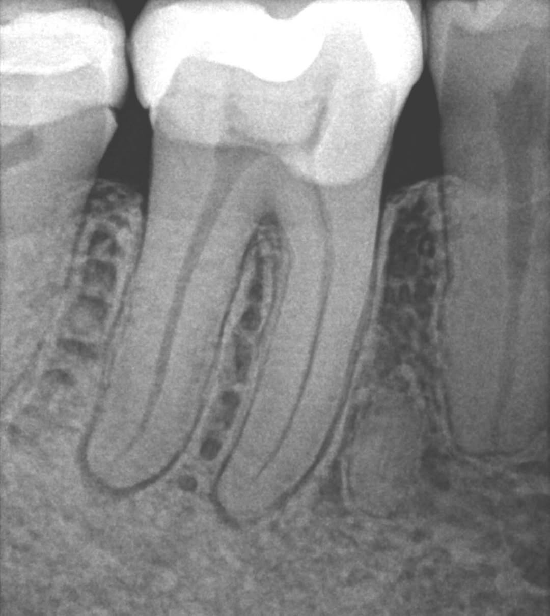 Instagram post by Dr. Jeff Kotsubo: Tooth #30 GentleWave procedure pre-operative and final radiographs. Clean. Simple. Minimal rotary instrumentation preserves root dentin. #ro…