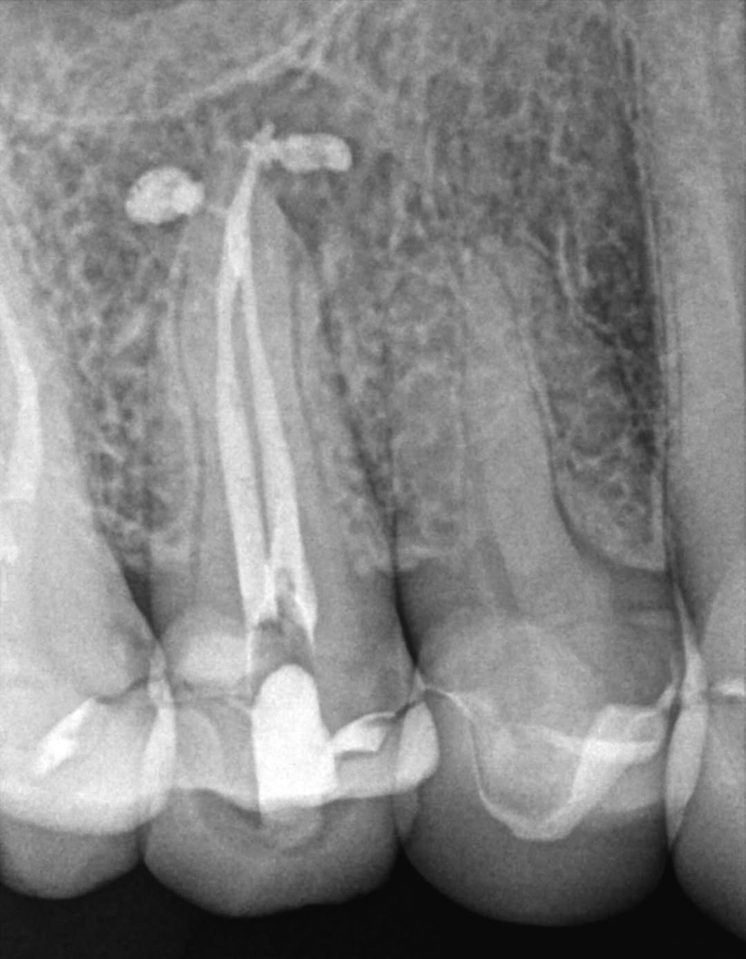Instagram post by Dr. Jeff Kotsubo: Our GentleWave treatment of a necrotic #5. A 6 month recall radiograph shows near complete apical osseous healing. Our patient had no compla…