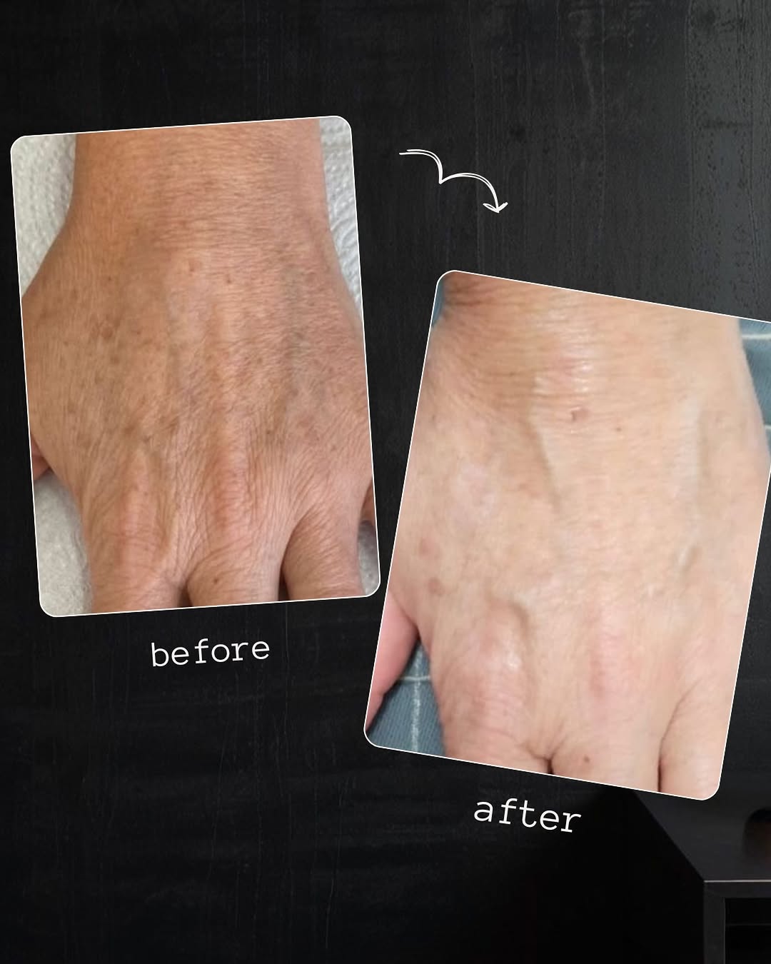 Instagram post by Dr. Jeff Rapaport: Your face may look younger—but your hands can still reveal your age. Even with a beautifully refreshed face, the hands often show some of th…