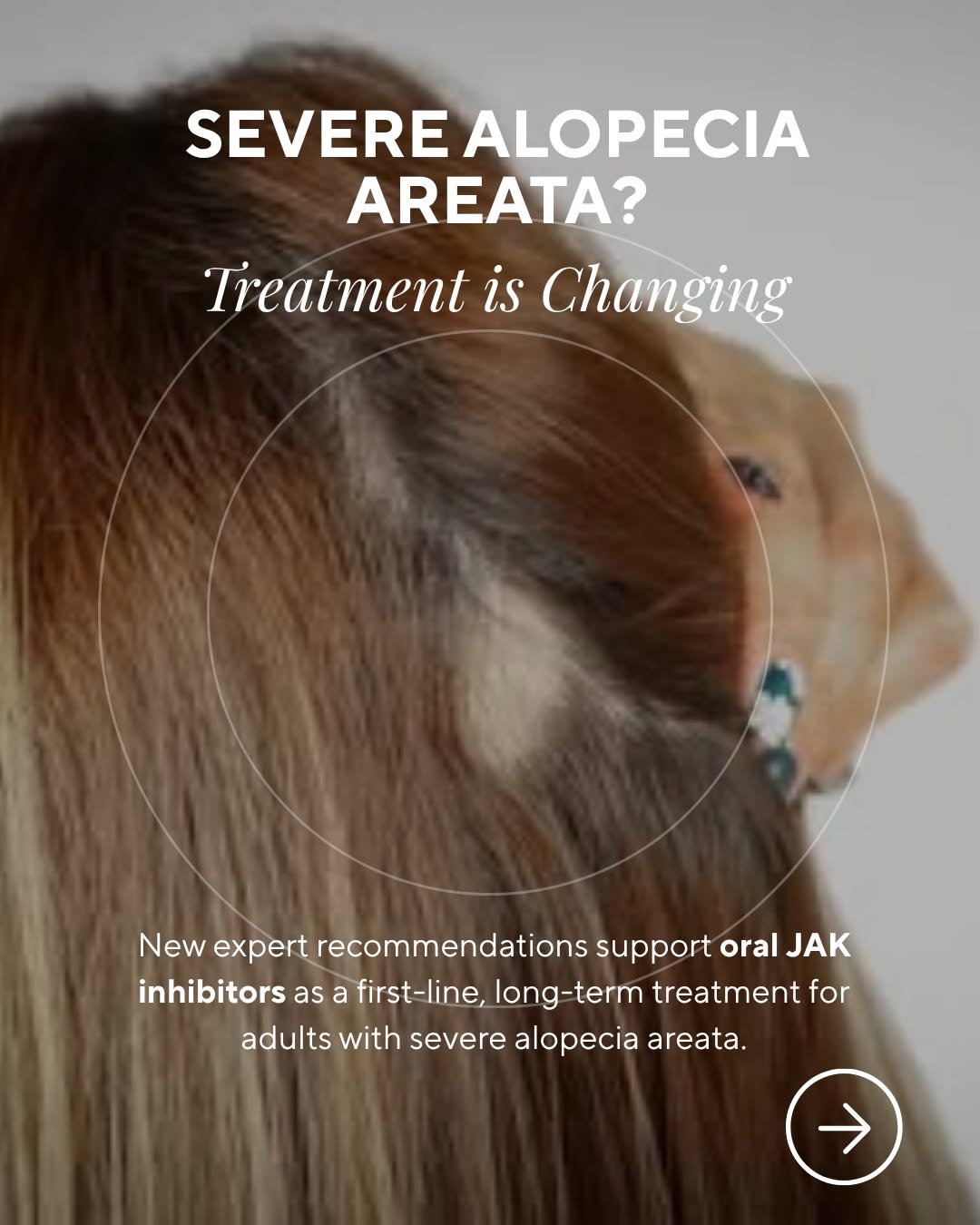 Instagram post by Dr. Jeff Rapaport: Severe alopecia areata is more than ordinary hair loss. It is an autoimmune condition, and for patients with significant disease, treatment …