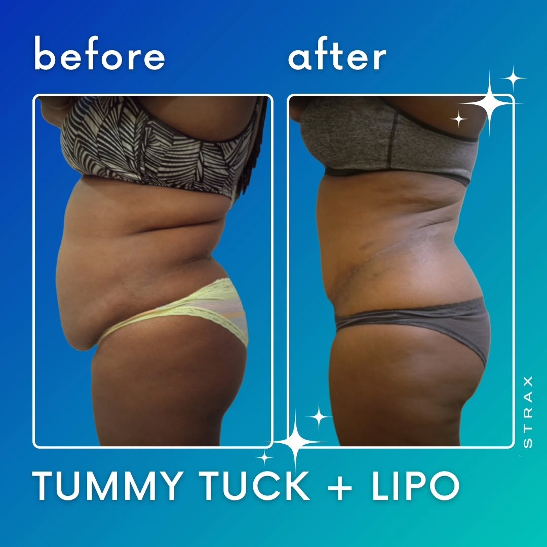 Instagram post by Dr. Jeffrey C. Hamm: Another great result of a Tummy Tuck and a Liposuction by the super talented Dr. Hamm 🌟 📲 DM @straxaesthetics for your free in-person or v…