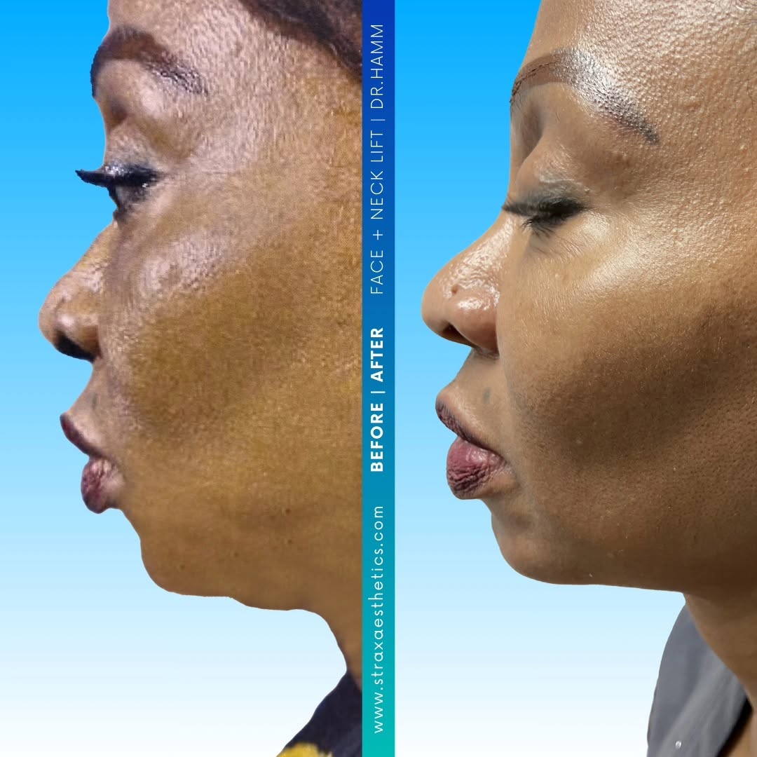 Instagram post by Dr. Jeffrey C. Hamm: A natural enhancement for our beautiful patient by performing a lower face and neck lift ✨️ 📲 DM @straxaesthetics for your free in-person o…