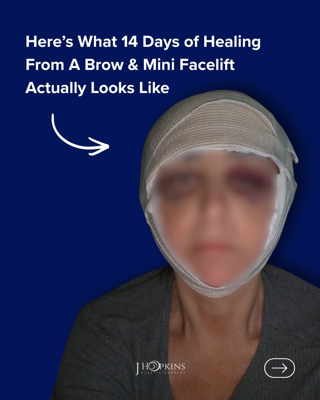 Instagram post by Dr. Jeffrey D. Hopkins: Same patient. Same procedure. VERY different days. 👀 #Facelift #FaceliftResults #FaceliftRecovery #PlasticSurgeryDallasTX #DallasTX