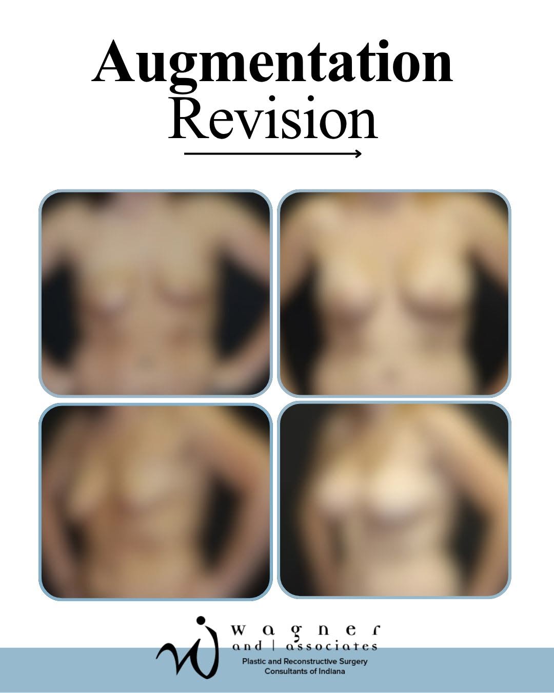 Instagram post by Dr. Jeffrey D. Wagner: Every patient’s anatomy is unique, and sometimes achieving balance requires a combination approach. For this breast revision case, breast im…