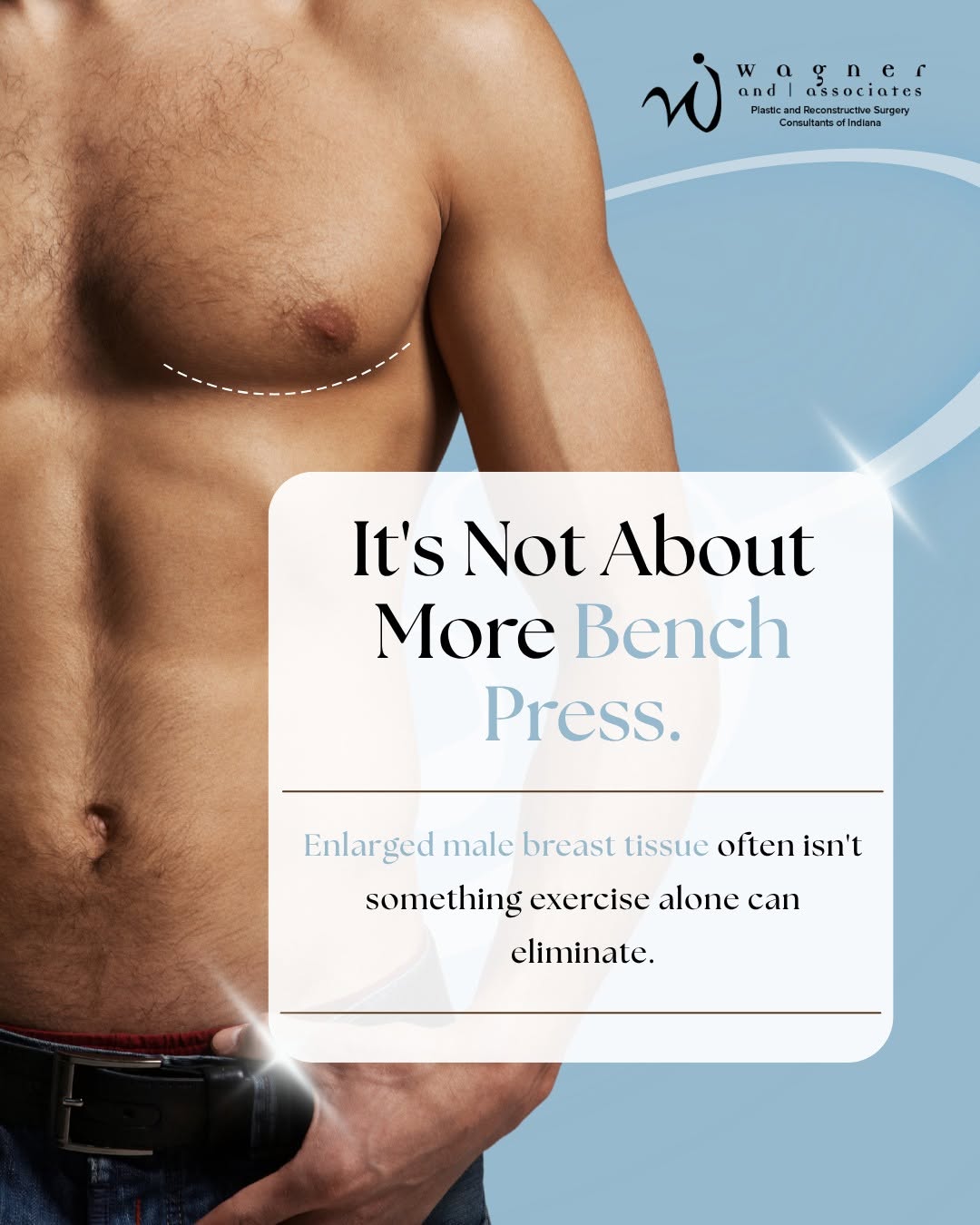 Instagram post by Dr. Jeffrey D. Wagner: For men with gynecomastia, enlarged breast tissue isn’t always something that exercise or diet alone can eliminate. Gynecomastia can affect …