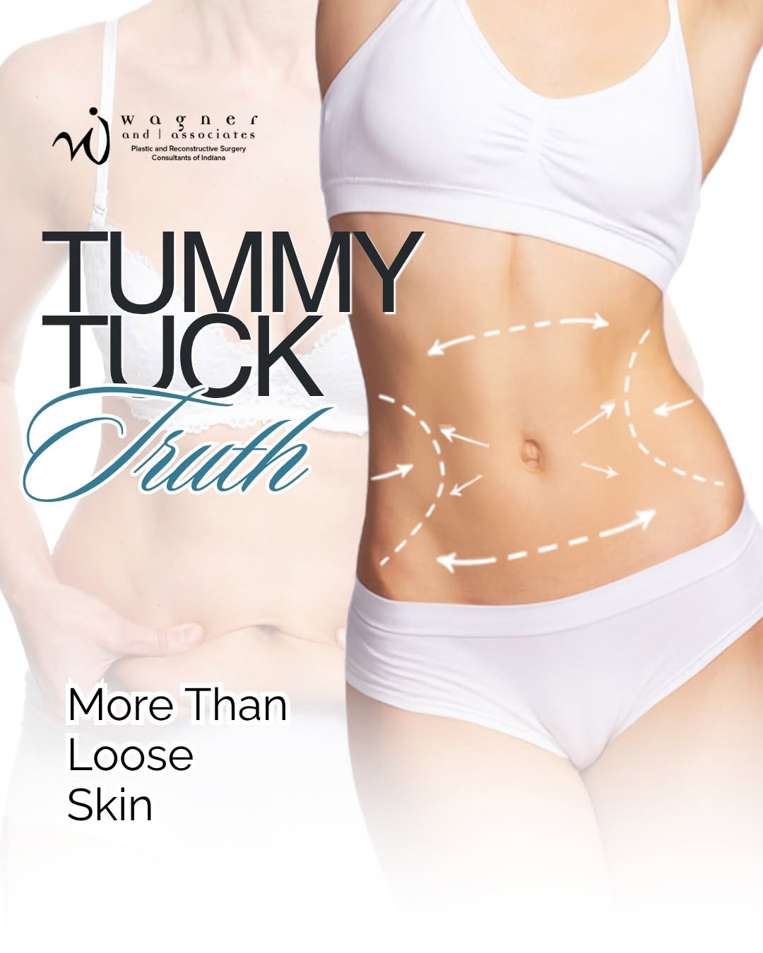 Instagram post by Dr. Jeffrey D. Wagner: There’s more to a tummy tuck than you might think. 👀 While most people associate a tummy tuck with removing excess skin, the procedure can …