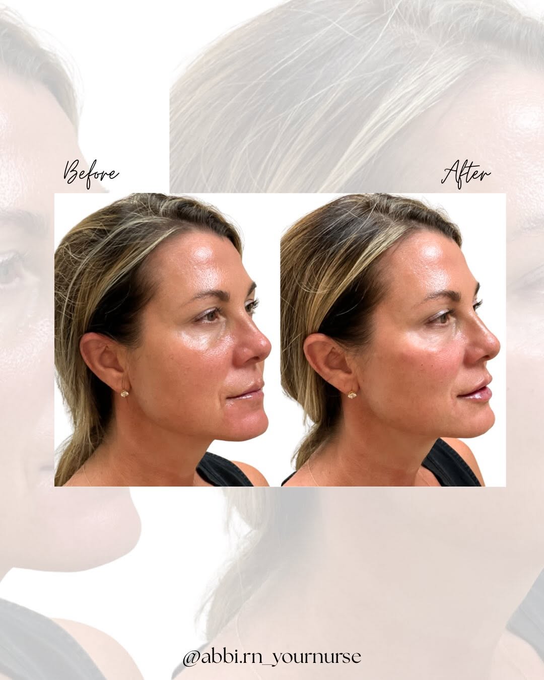 Instagram post by Dr. Jeffrey Ditesheim: It’s that “I can’t tell what she did, but she’s glowing” look. No dramatic changes. No obvious filler face. Just subtle restoration and feat…