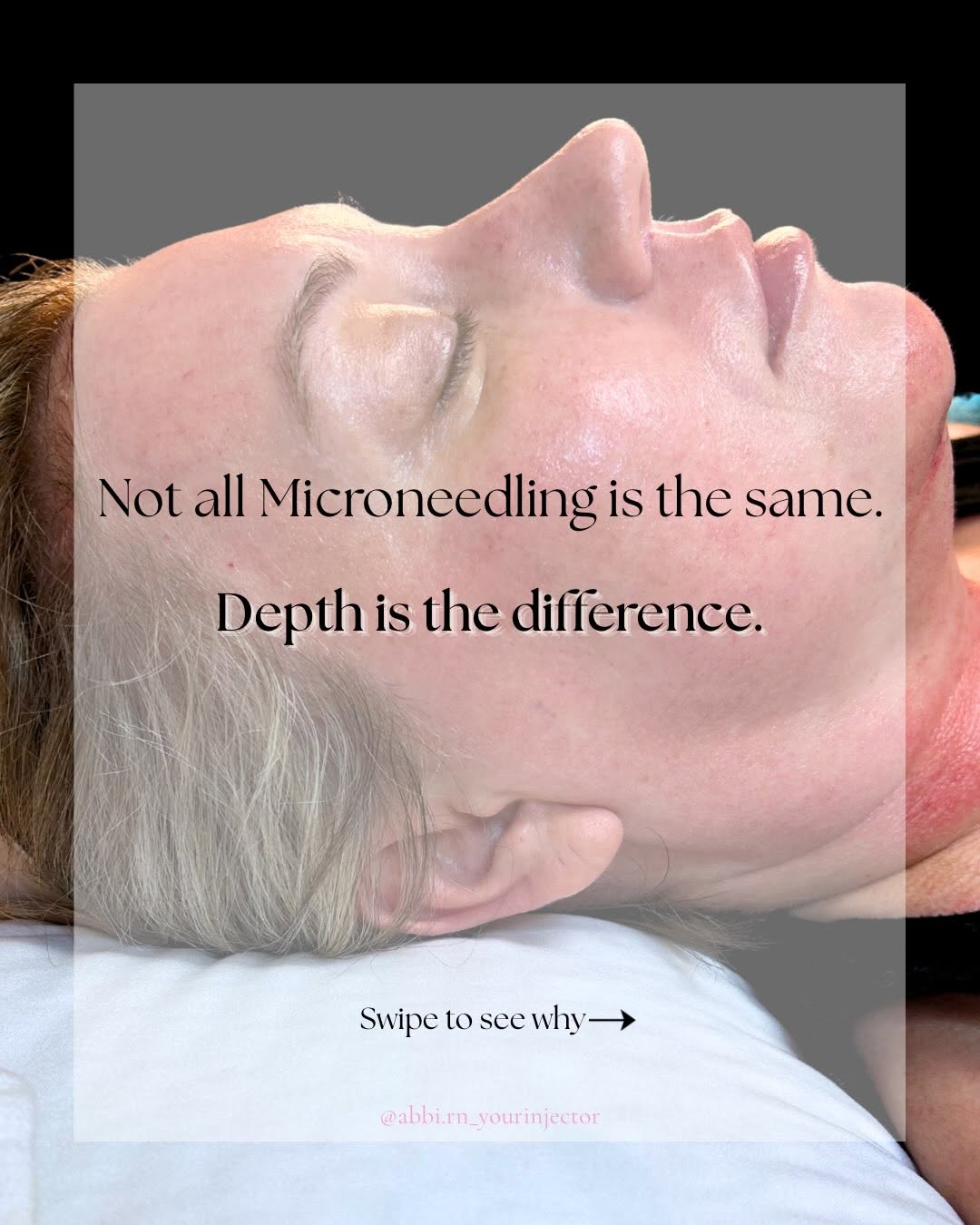 Instagram post by Dr. Jeffrey Ditesheim: Not all Microneedling is the same — depth is why. Needle depth determines what we can actually treat, from fine lines to deeper acne scarrin…