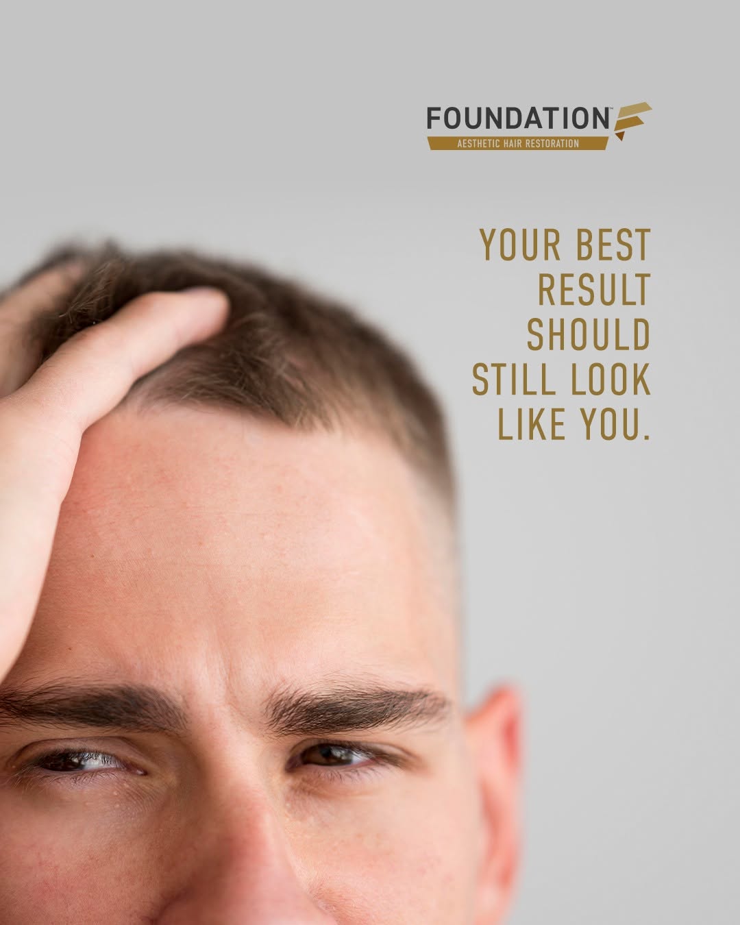 Instagram post by Dr. Jeffrey Epstein: Inspiration photos can be useful, but hair restoration isn't about recreating someone else's appearance. Your facial structure is yours. You…