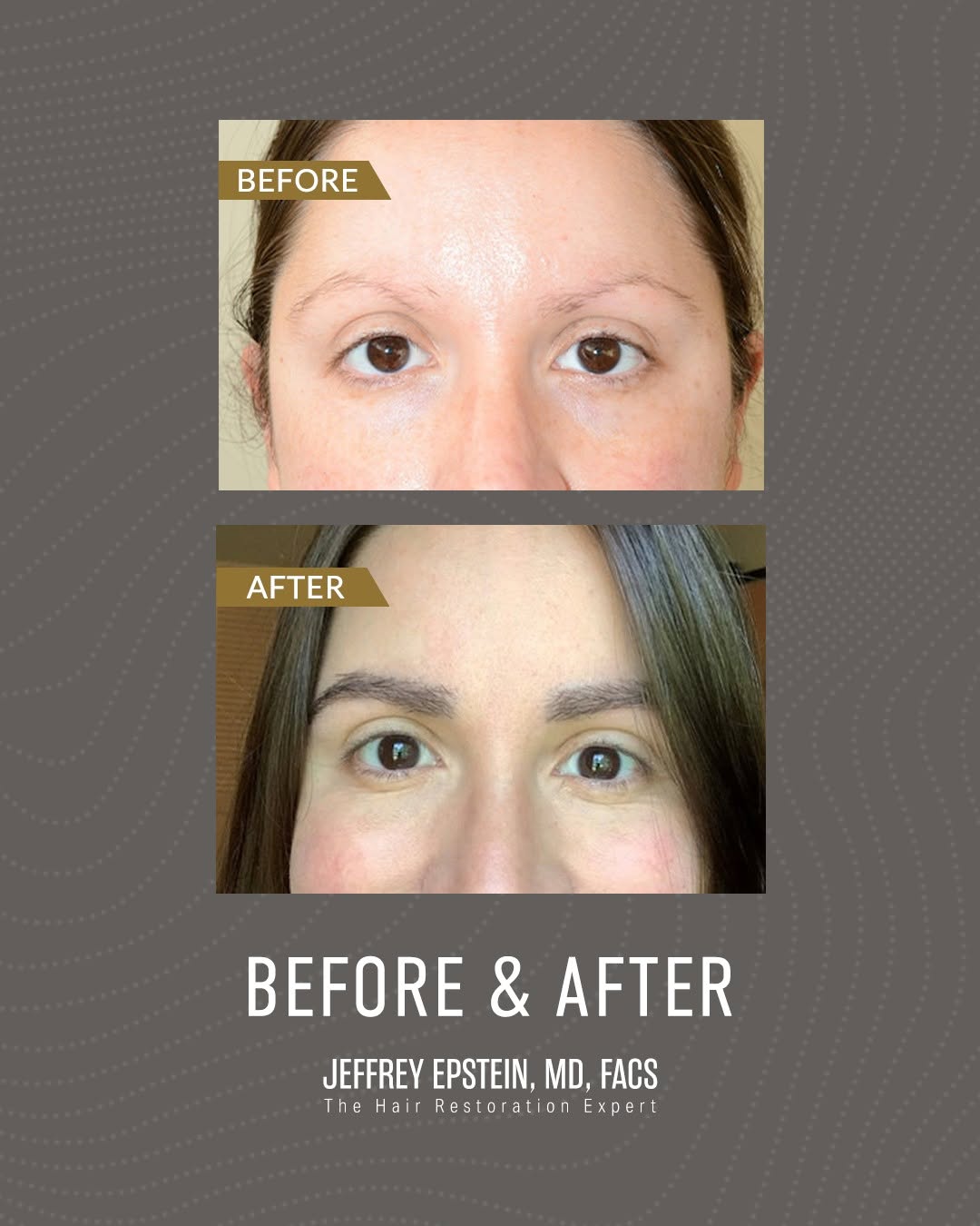 Instagram post by Dr. Jeffrey Epstein: Before and after eyebrow transplant. Call us at 305-697-0689 to learn more about hair restoration or to schedule a consultation at Foundatio…