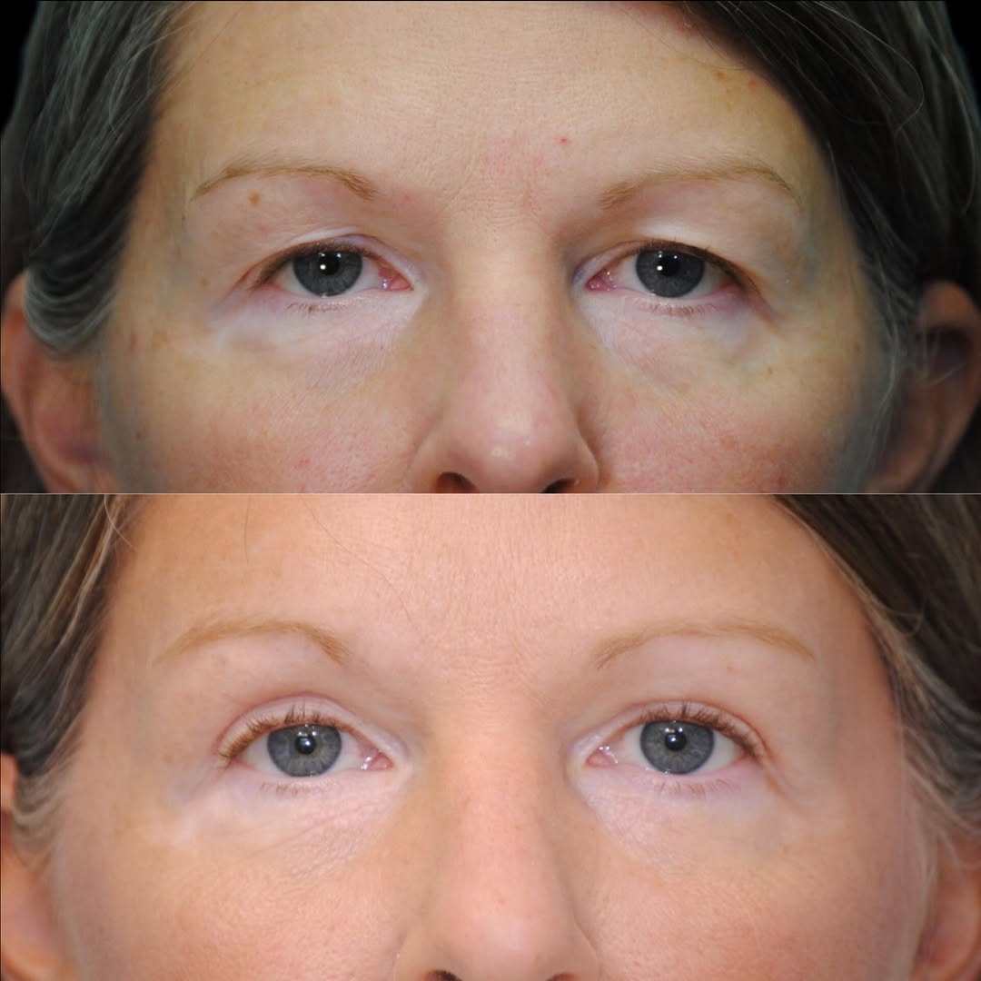 Instagram post by Dr. Jeffrey Joseph: ✨Glowing Results✨ One year following her endoscopic brow lift, upper and lower blepharoplasty, and fat transfer to the tear troughs, orbital…