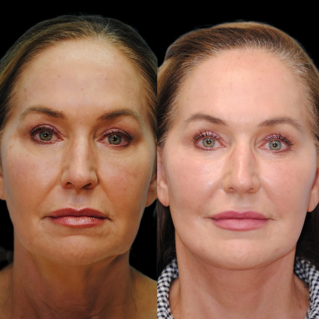 Instagram post by Dr. Jeffrey Joseph: Just one month following her Lift & Fill Facelift and Brow Lift with Dr. Joseph, this patient is enjoying a more defined jawline, brightened…