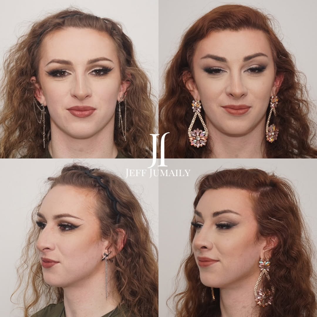 Instagram post by Dr. Jeffrey Jumaily: ✨ 5 Months Post-Op ✨ This beautiful patient is 5 months post-op from Facial Feminization Surgery. I had the pleasure of seeing her in clinic…