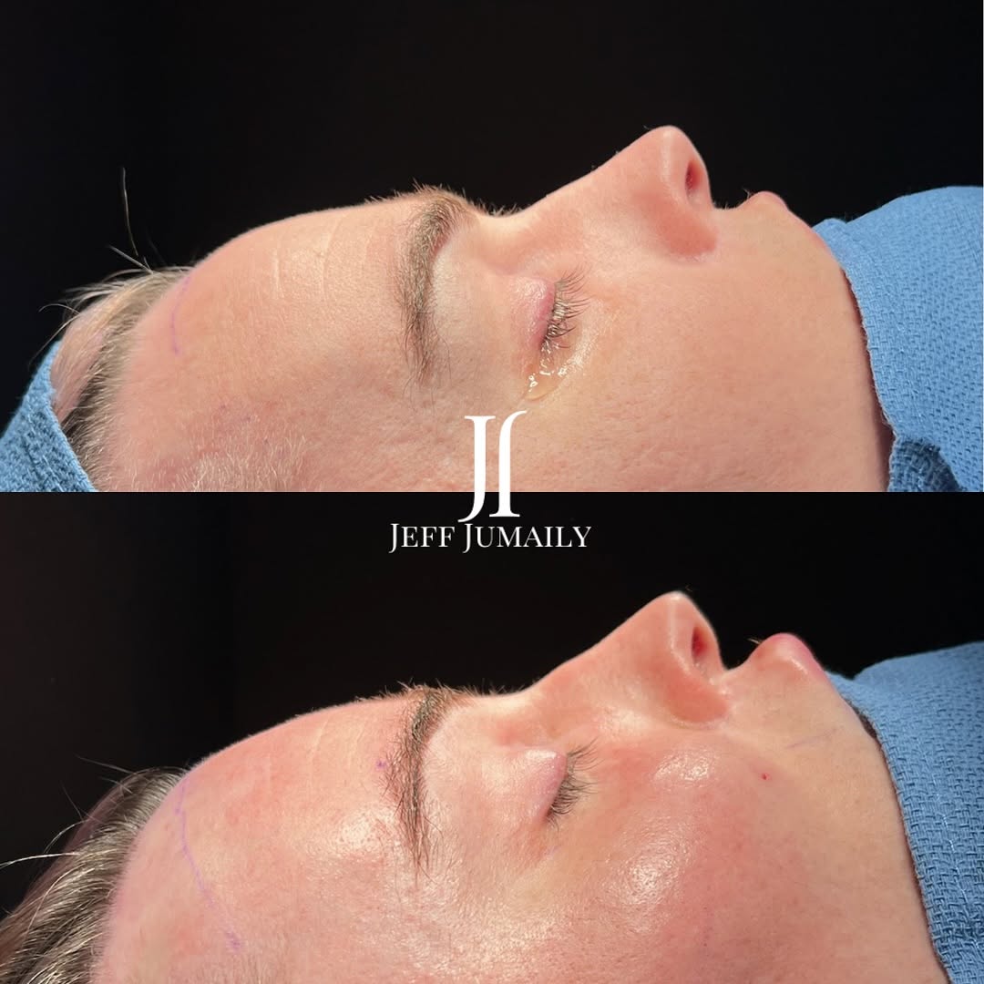 Instagram post by Dr. Jeffrey Jumaily: Beautiful results from our Complete UpperFace Transformation (CUT). This procedure includes forehead contouring (Type III), orbital rim cont…