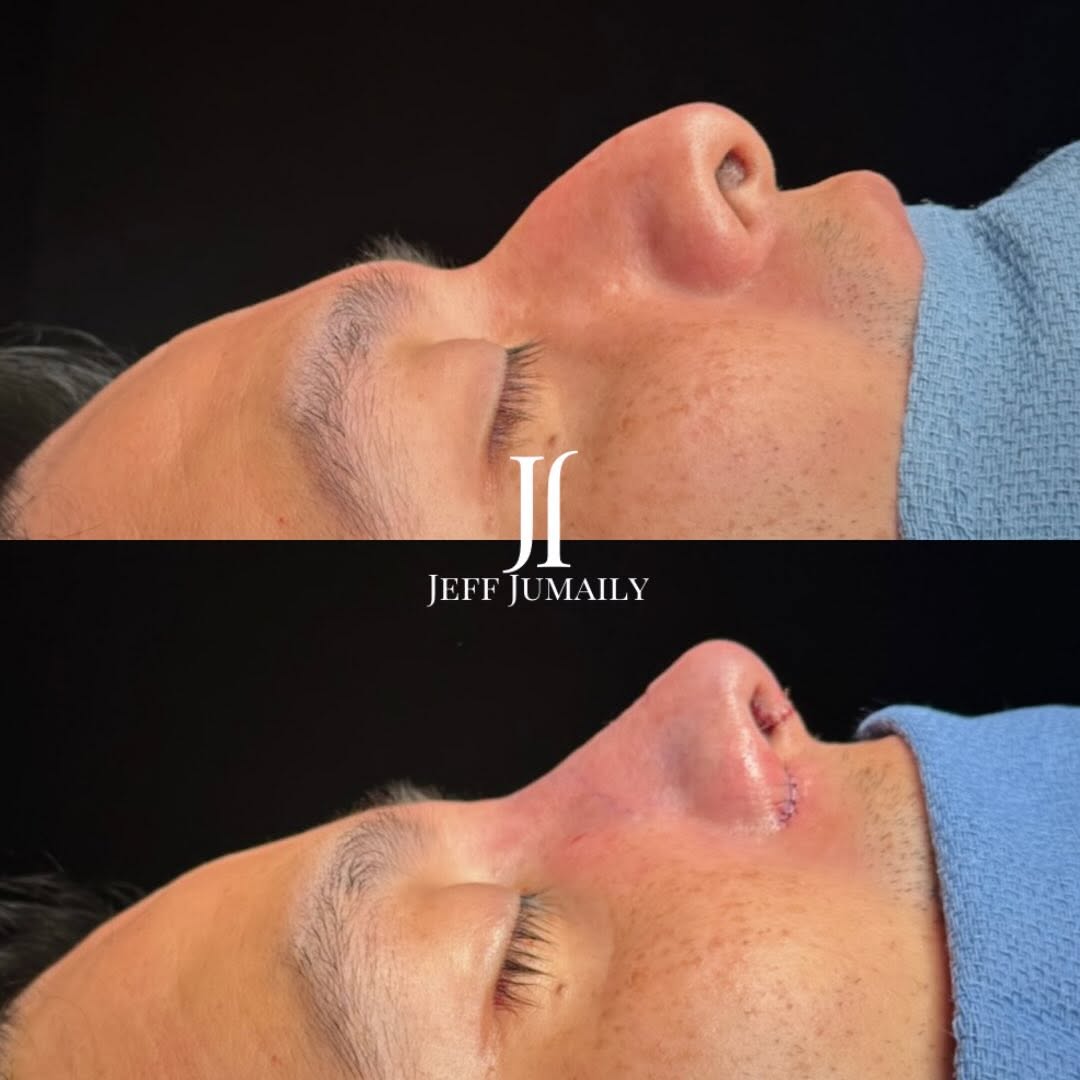 Instagram post by Dr. Jeffrey Jumaily: Male rhinoplasty is designed to refine, not redefine. A study in proportion, balance, and quiet confidence- a procedure where structure meet…