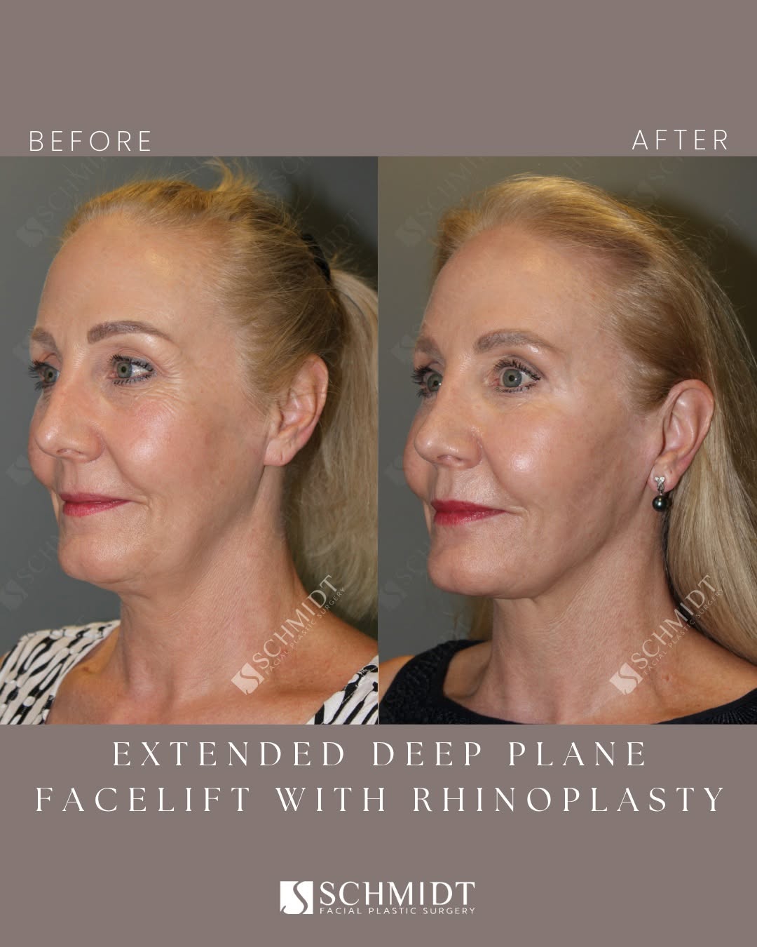 Instagram post by Dr. Jeffrey L. Schmidt: My 61-year-old patient, Jan, came to me for facial rejuvenation and to improve the symmetry of her face. She was particularly interested in …