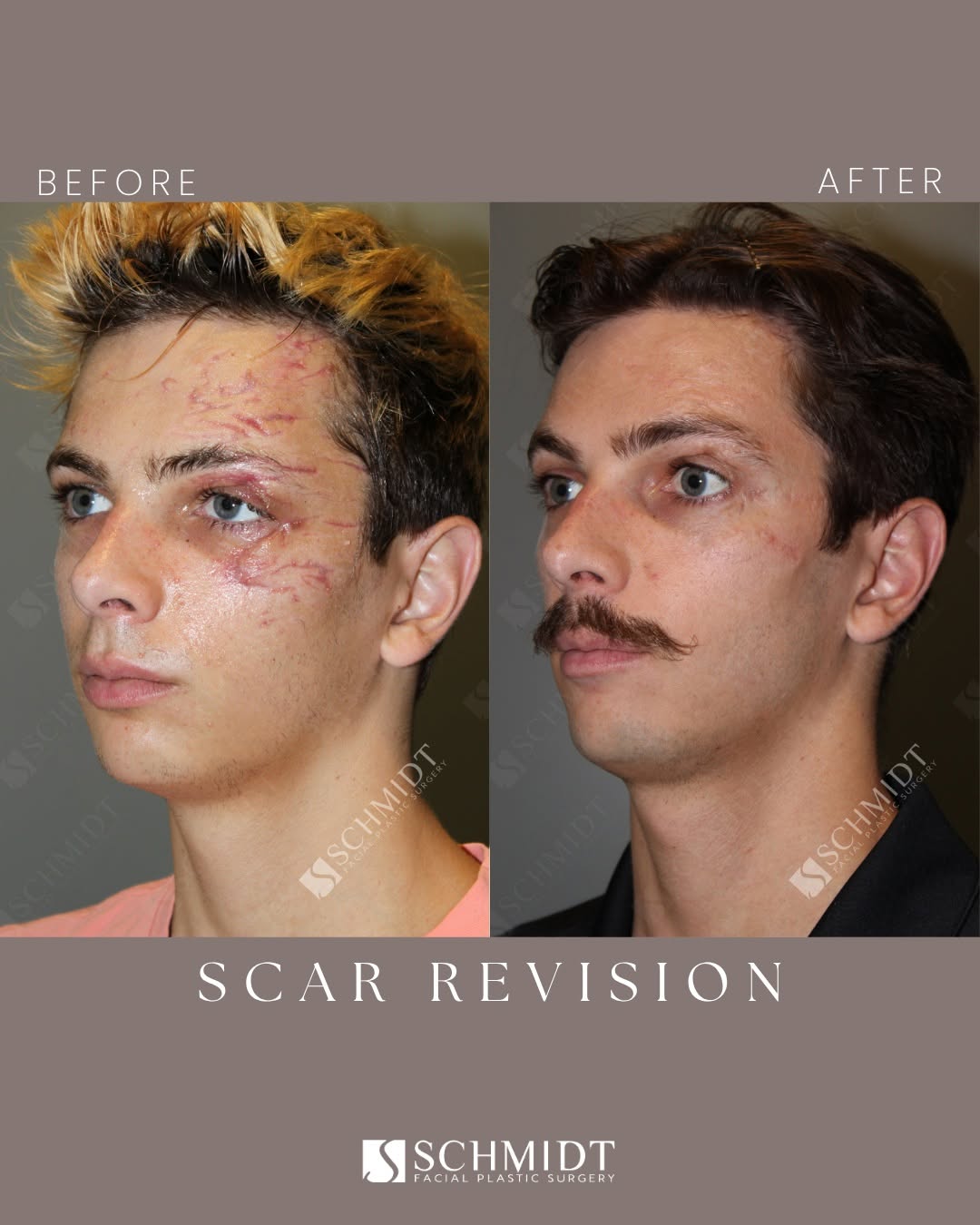 Instagram post by Dr. Jeffrey L. Schmidt: Andrew experienced a traumatic car accident that left him with multiple lacerations, avulsions, and significant soft tissue damage to his fa…