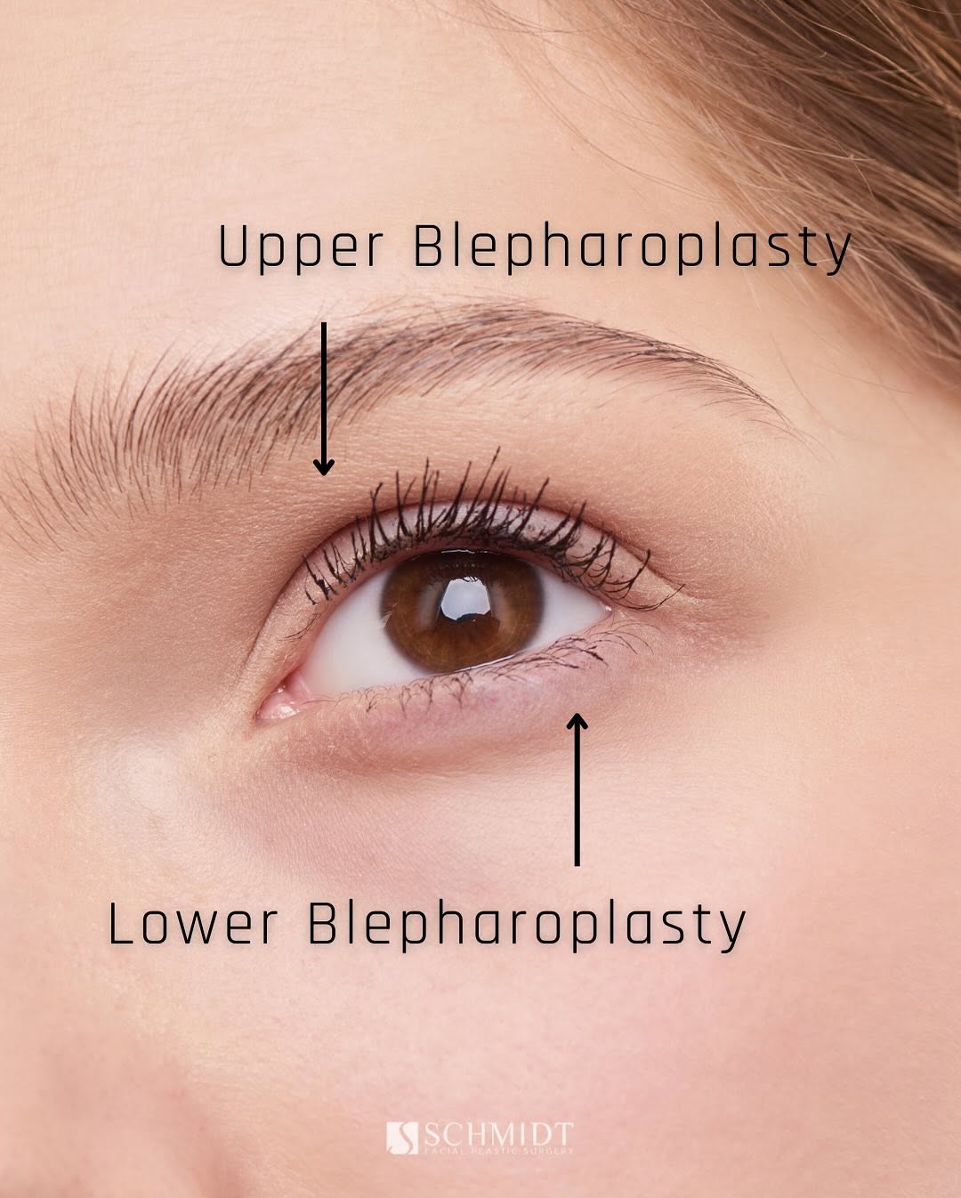 Instagram post by Dr. Jeffrey L. Schmidt: Want to say goodbye to tired eyes? 👀👋 As a double board-certified facial plastic surgeon, I’ve had the privilege of helping countless p…