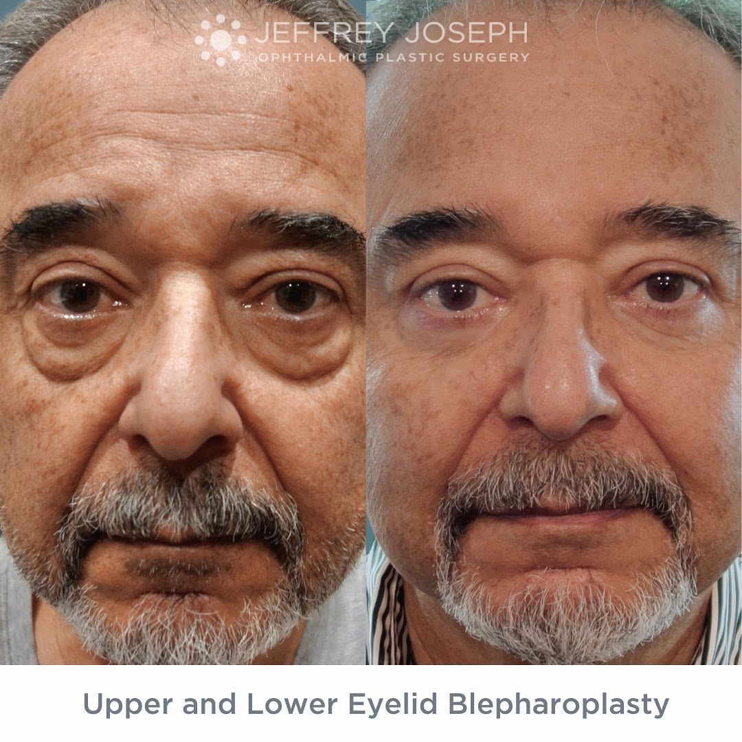 Instagram post by Dr. Jeffrey M. Joseph: Amazing transformation for this gentleman! 👏🏼 This was one of our favorite results for one of our favorite patients. Natural results are i…