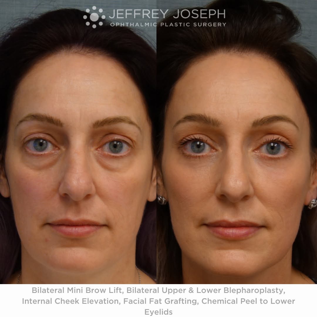 Instagram post by Dr. Jeffrey M. Joseph: We LOVE creating results like this for our patients! Our beautiful patient felt like she looked so tired even though she wasn’t. We hear thi…