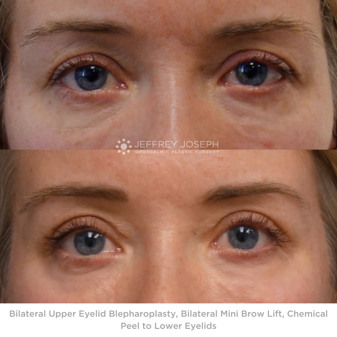 Instagram post by Dr. Jeffrey M. Joseph: Bright. Defined. Captivating. A subtle brow elevation and upper eyelid lift can completely transform how the eyes are perceived. She now has…