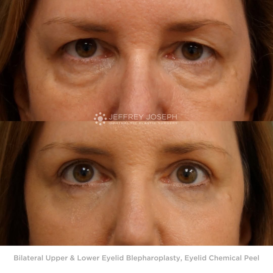 Instagram post by Dr. Jeffrey M. Joseph: 👀 Your eyes do a lot — they show emotion, personality, and sometimes a little tiredness too! Even small changes around the eyelids can make…