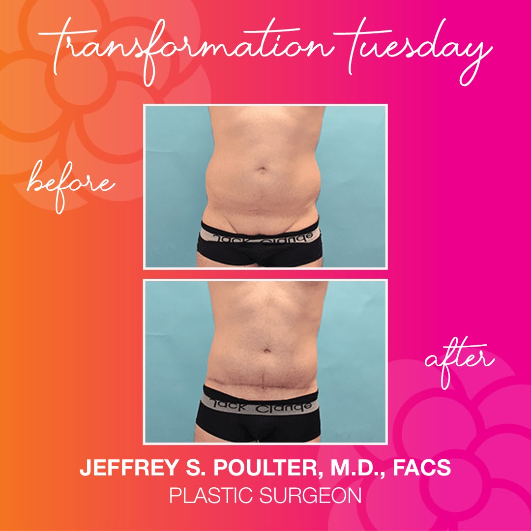 Instagram post by Dr. Jeffrey Poulter: Witness the incredible transformation because men can benefit from plastic surgery too! This 47-year-old patient struggled with stubborn wei…