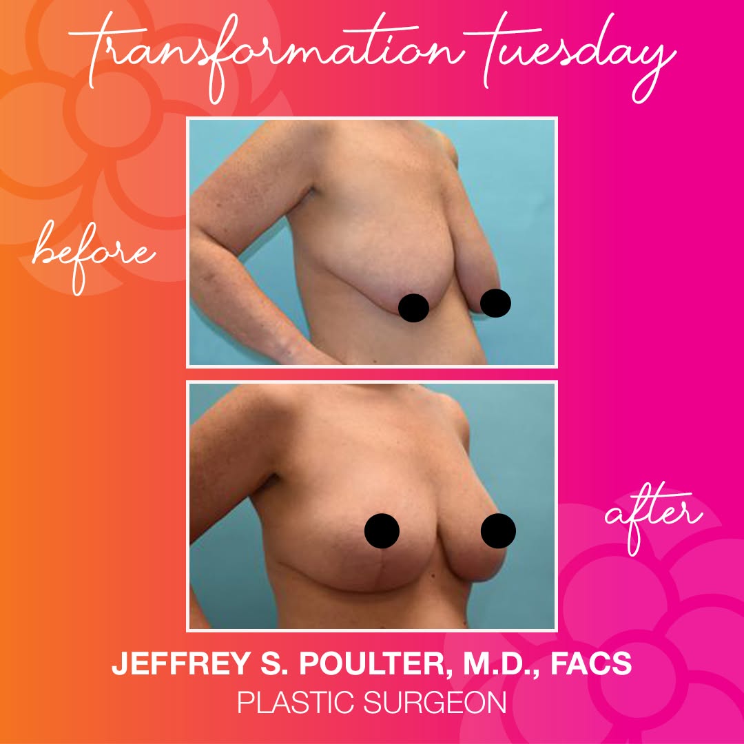 Instagram post by Dr. Jeffrey Poulter: Discover the beauty of a well-executed extended mastopexy (breast lift) with Dr. Poulter! This 33-year-old patient underwent a transformatio…
