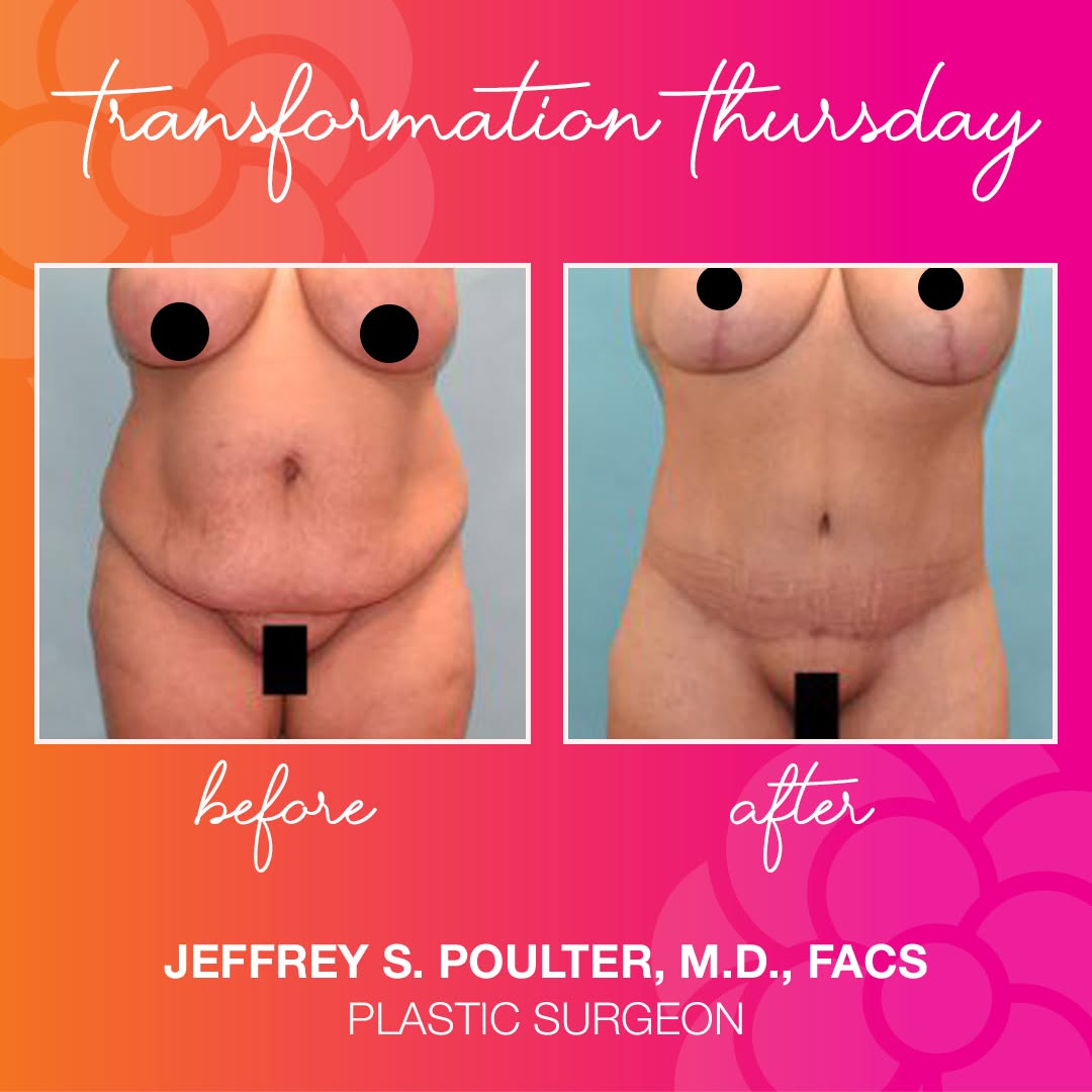 Instagram post by Dr. Jeffrey Poulter: This incredible 51-year-old patient lost over 50 lbs! Her first procedure was an extended abdominoplasty with liposuction to the hips and la…