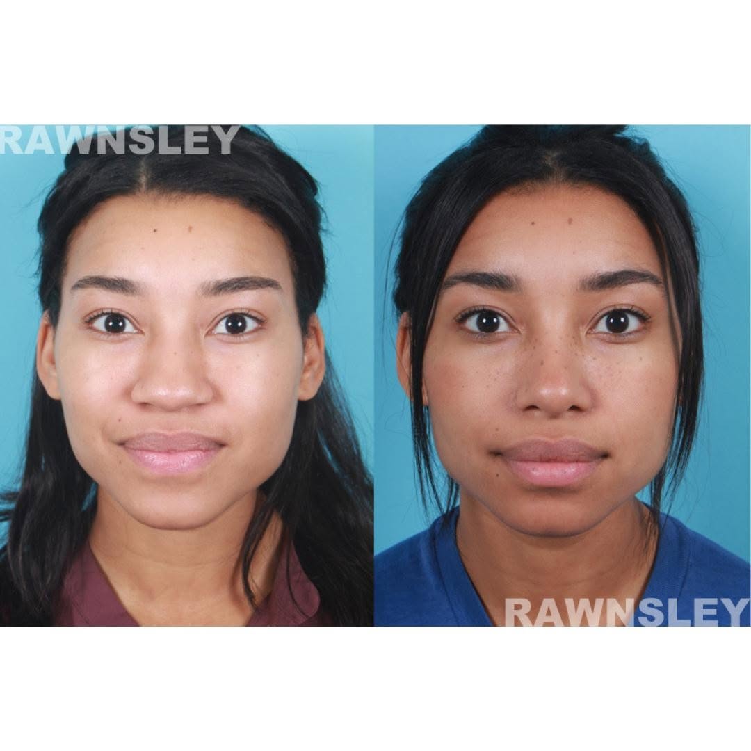 Instagram post by Dr. Jeffrey Rawnsley: Ethnic Rhinoplasty results.. #BeforeAfter #Rhinoplasty #PlasticSurgery #Nosejob