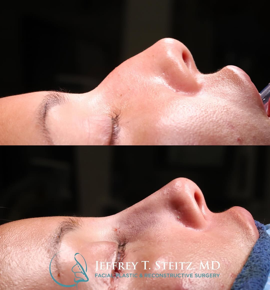 Instagram post by Dr. Jeffrey T. Steitz: Here are some intraoperative pics of a primary rhinoplasty, minimal access approach for preservation rhinoplasty. Here I did only a dorsal h…